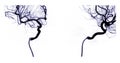 Cerebral angiography  image from Fluoroscopy in intervention radiology  showing cerebral artery Royalty Free Stock Photo