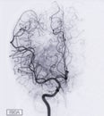 Cerebral angiography  image from Fluoroscopy in intervention radiology  showing cerebral artery Royalty Free Stock Photo