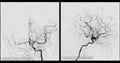 Cerebral angiography  image from Fluoroscopy in intervention radiology  showing cerebral artery Royalty Free Stock Photo