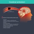 Cerebral embolism. Infographic Illustration. Anatomical human and Health care.