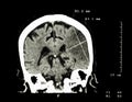 Cerebral infarction at left hemisphere ( Ischemic stroke ) ( CT-scan of brain ) : Medicine and Science background