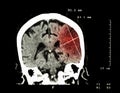 Cerebral infarction at left hemisphere ( Ischemic stroke ) ( CT-scan of brain ) : Medicine and Science background Royalty Free Stock Photo