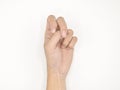 Cerebral palsy hand in Asian young male patient. Typically seen in hemiplegia and quadriplegia. Wrist joint flexion with ulnar