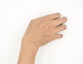 Cerebral palsy hand in Asian young male patient. Typically seen in hemiplegia and quadriplegia. Wrist joint flexion with ulnar