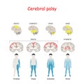 Cerebral palsy. Human brain with area Mixed, Ataxic, Dyskinetic, and Spastic palsy Royalty Free Stock Photo