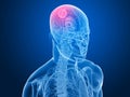 Cerebral tumor Royalty Free Stock Photo