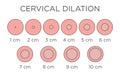 Cervial Dilation Medical Illustration - chart in centimeters Royalty Free Stock Photo