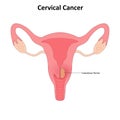 Cervical cancer vector illustration Royalty Free Stock Photo