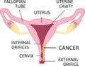 Cervical Cancer. Carcinoma of Cervix. Malignant neoplasm arising from cells in the cervix uteri Royalty Free Stock Photo