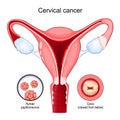 Cervical cancer. Carcinoma. Malignant Royalty Free Stock Photo