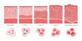 Cervical cancer cells elongated Dysplasia stages infographic Female reproductive system squamous cell carcinoma uterus