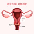 Cervical cancer image