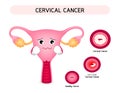 Cervical cancer diagram with sadness uterus cartoon character.