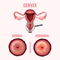 Cervical cancer image Royalty Free Stock Photo