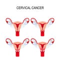 Cervical cancer staging. Carcinoma of Cervix.