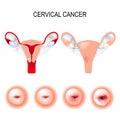 Cervical cancer staging Royalty Free Stock Photo