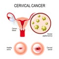 Cervical cancer. uterus, cervix, and close-up of the Human papillomavirus Royalty Free Stock Photo