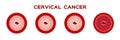 Cervical cancer in women uterus / anatomy