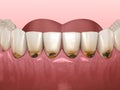 Cervical caries on frontal teeth. Medically accurate tooth 3D illustration Royalty Free Stock Photo