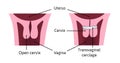 Cervical cerclage tightening of cervical opening during pregnancy. problem, injury. uterus with open cervix and light