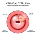 Cervical dysplasia. Close-up of a cervix. Cervical cancer