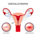Cervical ectropion. cervical erosion