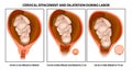 Cervical effacement and dilatation