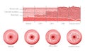 Cervical invasive cancer intraepithelial neoplasia Dysplasia 1 2,3 and normal stage cell morphology on pap smear test