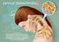 Cervical Osteochondrosis Royalty Free Stock Photo