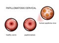 Cervical papillomatosis. human papilloma virus Royalty Free Stock Photo