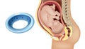 Gynecological and obstetric pessary. Cervical pessary in pregnant women with a short cervix. Modeling of effective Royalty Free Stock Photo