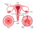 Cervical polyps. Uterus with cervix marked with lines. Small and large polyps are shown in anterior view and inside