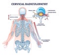 Cervical radiulopathy as painful neck nerve irritation outline diagram Royalty Free Stock Photo