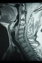 Cervical Spine MRI Royalty Free Stock Photo