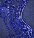 spinal cord tumor, illustration, MRI Royalty Free Stock Photo