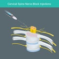 Cervical Spine Nerve Block Injections.