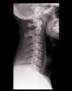 Cervical spine on x-ray