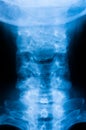 Cervical spine x-ray