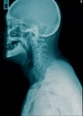 Cervical spine x-ray image