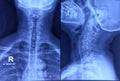 Cervical spine x-ray showing spondylosis of cervical spine.