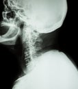 Cervical spondylosis . Film x-ray of cervical spine ( lateral position ) ( side view ) Royalty Free Stock Photo