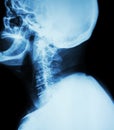 Cervical spondylosis . Film x-ray of cervical spine ( lateral position ) ( side view ) Royalty Free Stock Photo