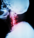 Cervical spondylosis . Film x-ray of cervical spine ( lateral position ) ( side view ) Royalty Free Stock Photo