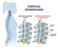 Cervical spondylosis problem compared with healthy spine outline diagram