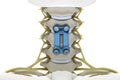 Cervical vertebrae fixed with a metal plate and screws. 3d render image