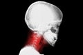 Cervical vertebrae, neck pain