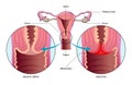 Cervicitis medical illustration