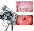 Cervix - Abnormal Colposcopy