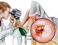 Cervix - Cervical Laser Surgery Royalty Free Stock Photo