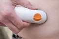 CGM - Continuous glucose monitoring: Dexcom g6 sensor installationon on a belly . Type 1 Diabetes